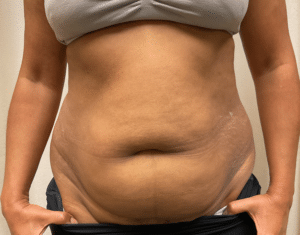 Before Image: Abdominoplasty