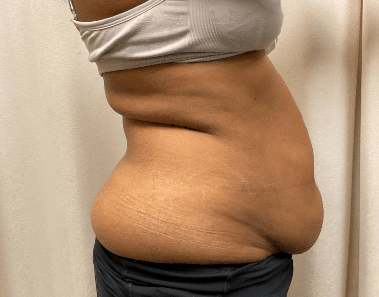 Before Image: Abdominoplasty - front