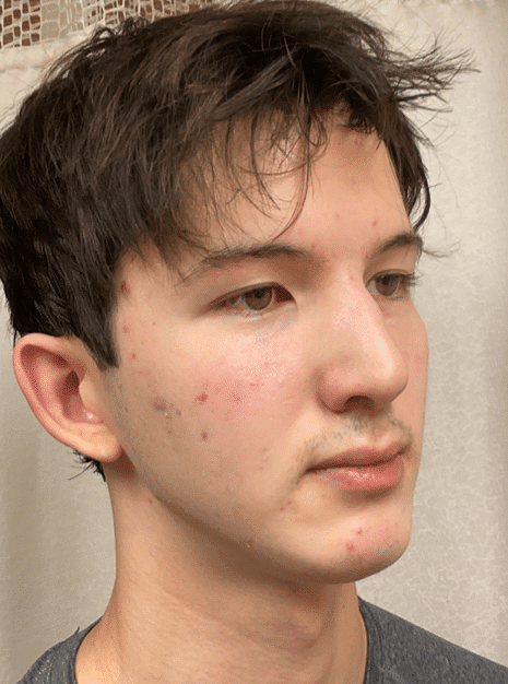After Image: Chin Augmentation -