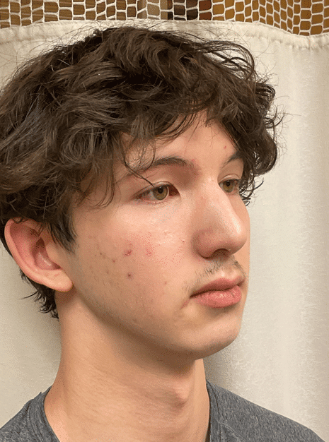 Before Image: Chin Augmentation -