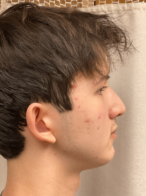After Image: Chin Augmentation - right-side