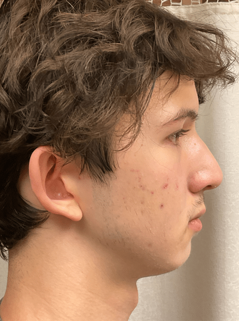 Before Image: Chin Augmentation - right-side